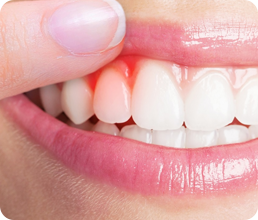 Diş Eti Hastalıkları